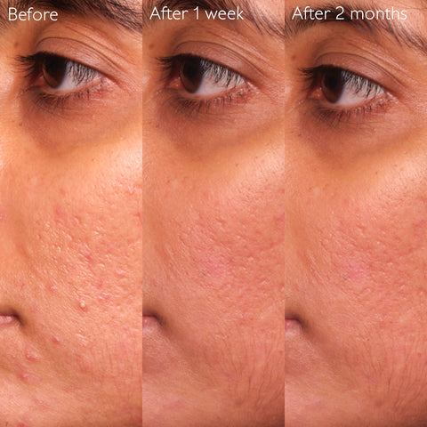 Caudalie Vinopure Blemish Control Salicylic Serum