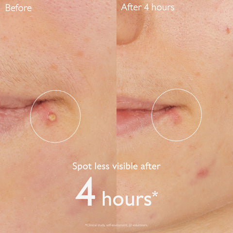Caudalie Vinopure Salicylic Spot Solution